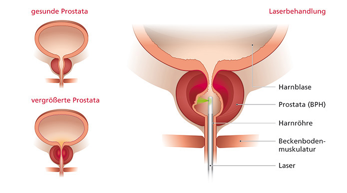 Medizinische Illustrationen zur Erklärung urologischer Themen