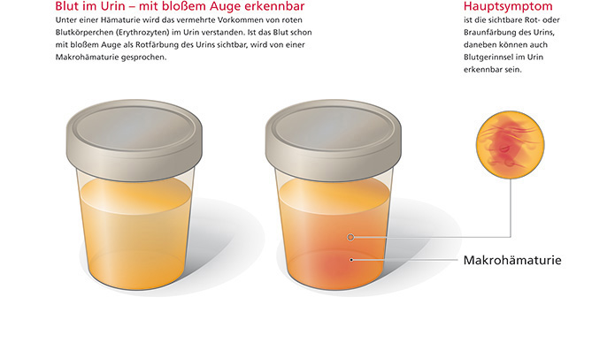 Medizinische Illustrationen zur Erklärung urologischer Themen