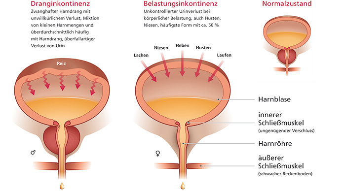 Medizinische Illustrationen zur Erklärung urologischer Themen